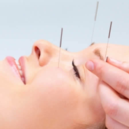 Close up view of a smiling woman receiving acupuncture on her eyebrows and cheeks